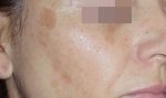 The Cosmelan® Method for Hyperpigmentation Hot on Sale