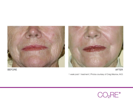 CO2 Fractional Laser Treatments Online Hot Sale