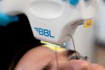 BBL Laser Treatment Hot on Sale