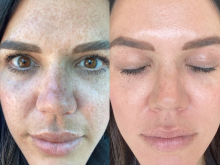 The Cosmelan® Method for Hyperpigmentation Hot on Sale