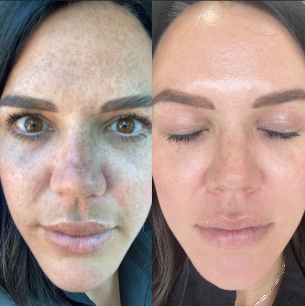 The Cosmelan® Method for Hyperpigmentation Hot on Sale